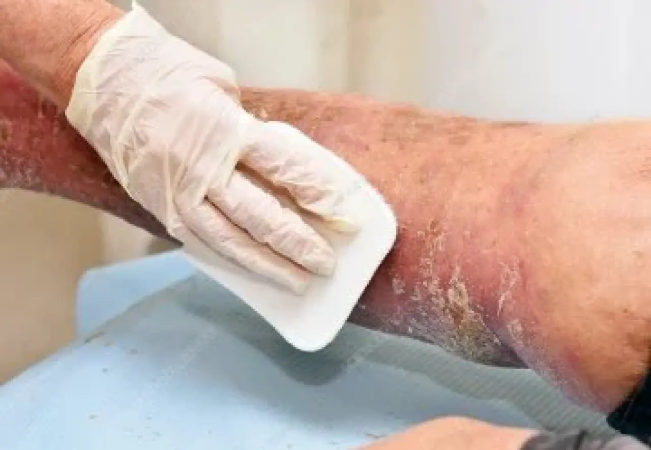 Debridman Nedir, Ameliyatı Nasıl Olur, Tedavi Yöntemleri Nelerdir? 2