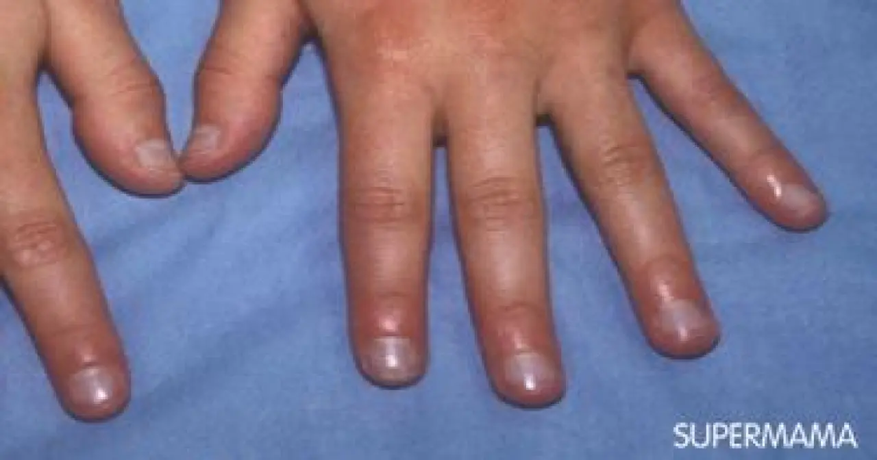 Soluk, Sarı, Mavi... Tırnaklar Ne Söylüyor? 4