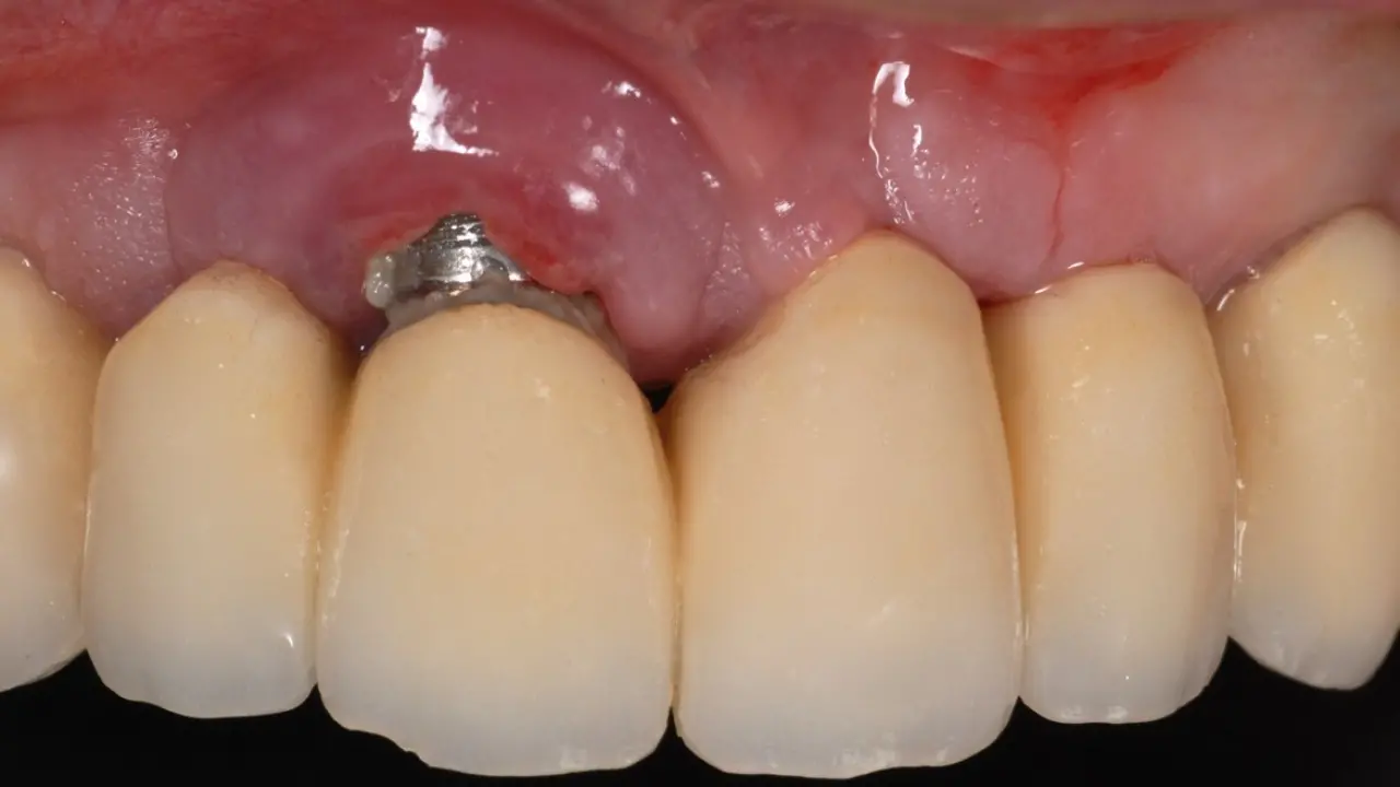 Kemik Kaybına Götüren Sessiz Düşman 2