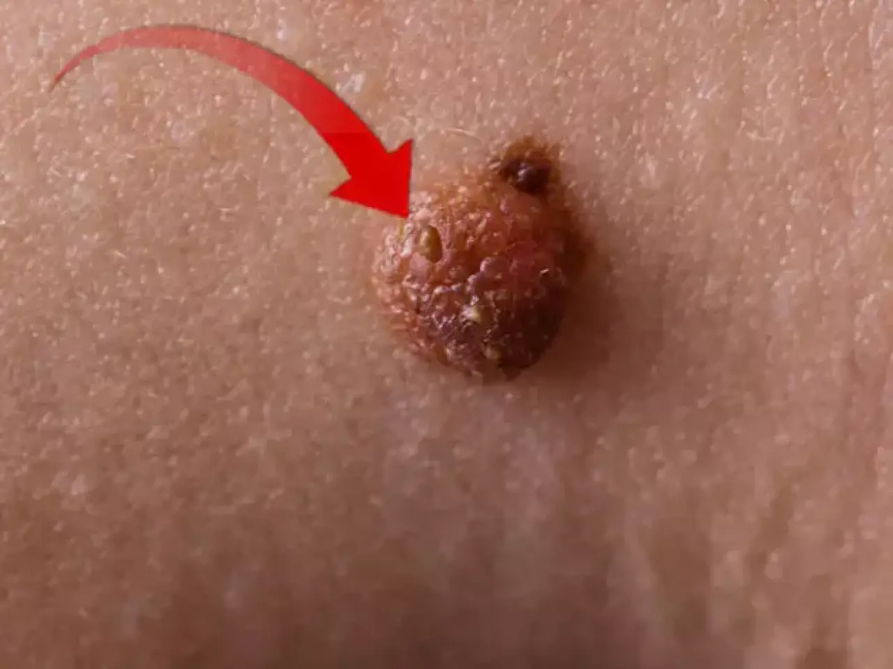 Benlerinizdeki değişiklikler tehlikeli mi? Uzmanlar sürekli gözlem yapmanızı öneriyor! 2