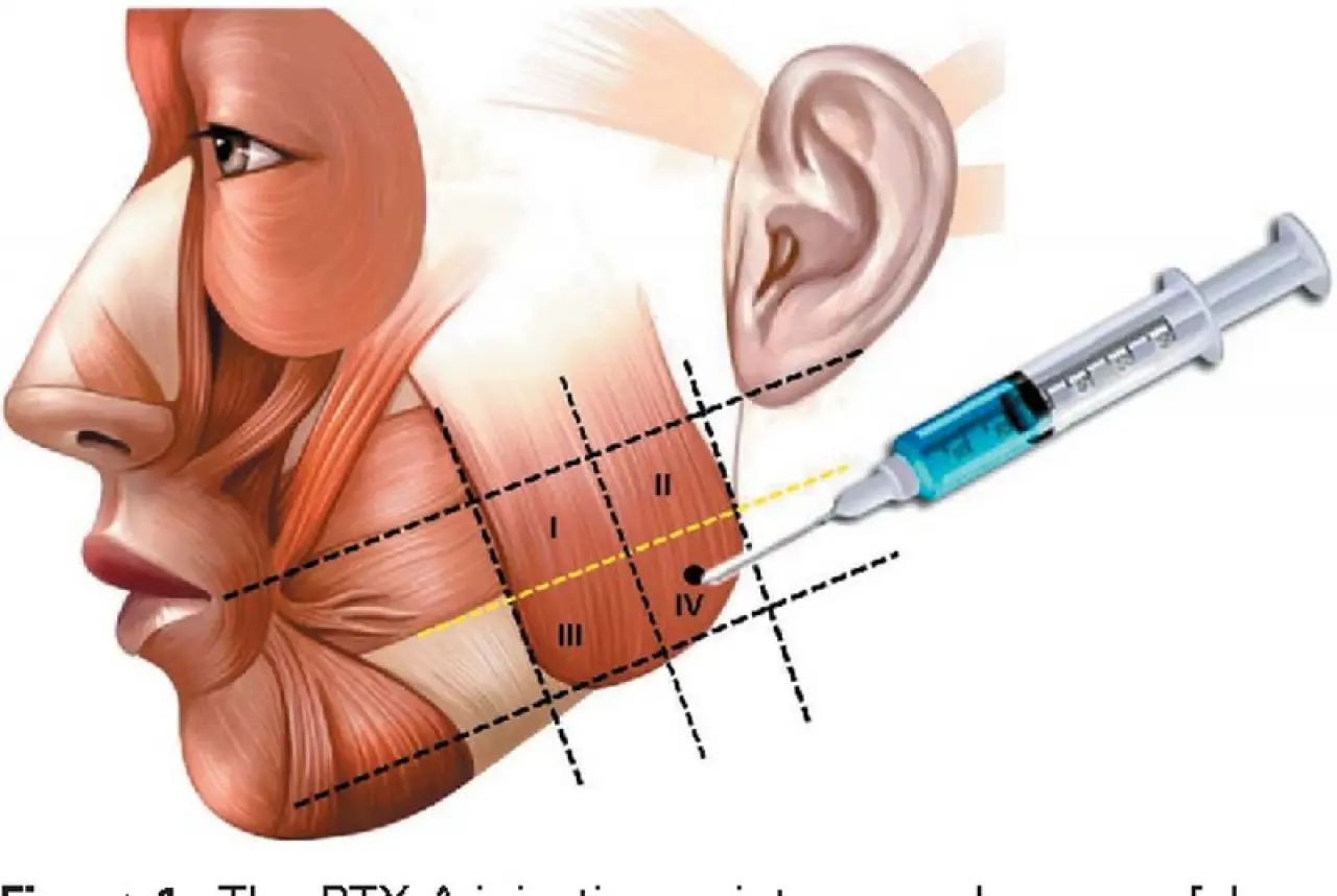 Diş Sıkmaktan Kurtulmanın En Etkili Yolu: Masseter Botoksu Mucizesi! 3