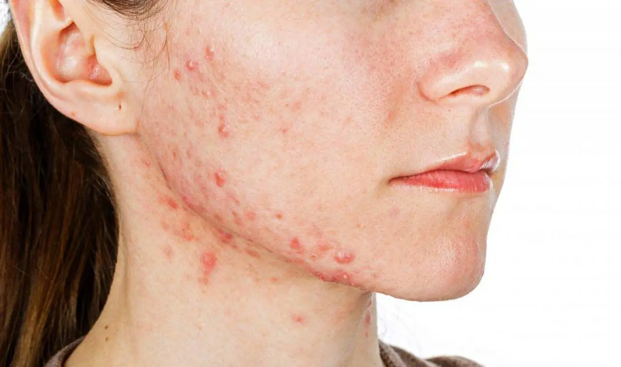 Yüzdeki Akne Yeme Bozukluklarını Tetikleyebilir: Yale Üniversitesi'nden Uyarı 1