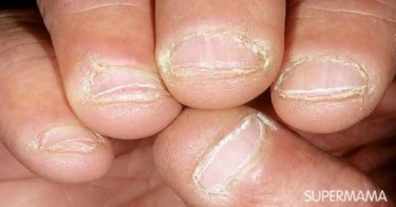 Soluk, Sarı, Mavi... Tırnaklar Ne Söylüyor? 9