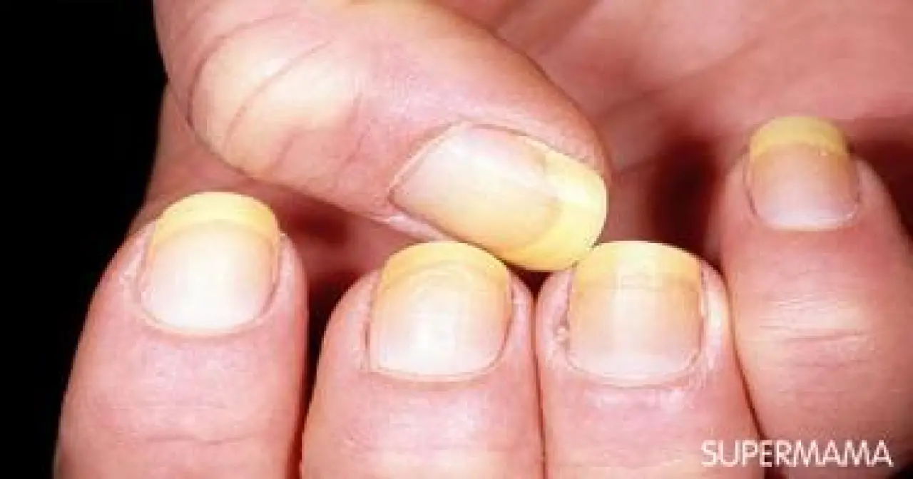 Soluk, Sarı, Mavi... Tırnaklar Ne Söylüyor? 3