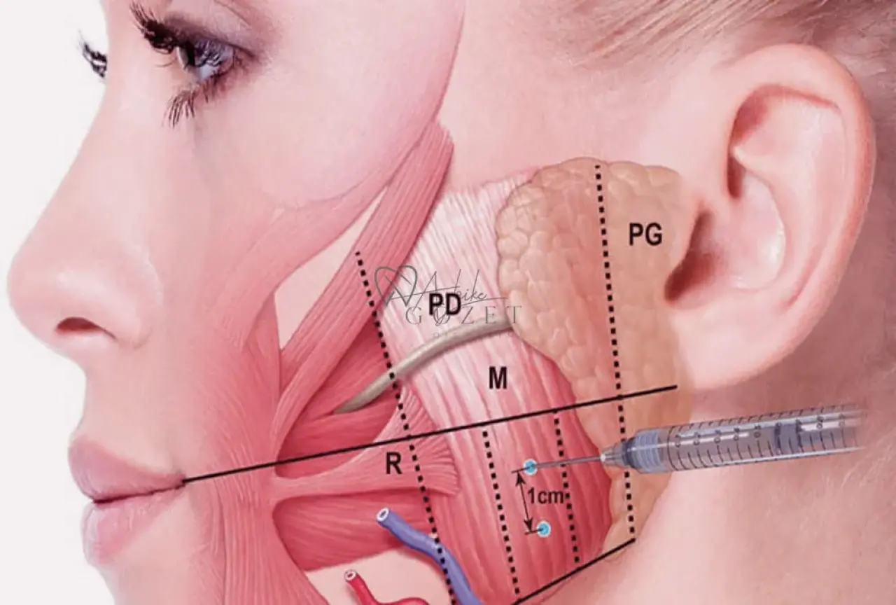 Diş Sıkmaktan Kurtulmanın En Etkili Yolu: Masseter Botoksu Mucizesi! 1