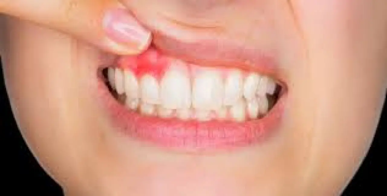 Diş Apsesi Hayati Tehlike Taşıyabilir! 1