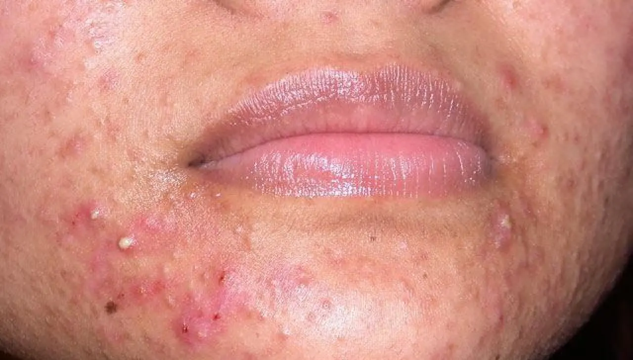 Yüzdeki Akne Yeme Bozukluklarını Tetikleyebilir: Yale Üniversitesi'nden Uyarı 3