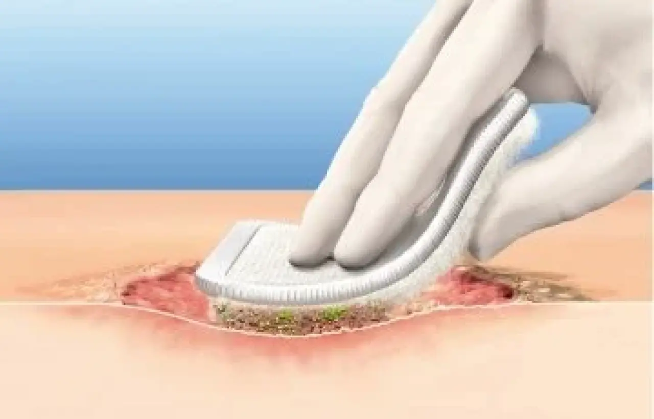 Debridman Nedir, Ameliyatı Nasıl Olur, Tedavi Yöntemleri Nelerdir? 1