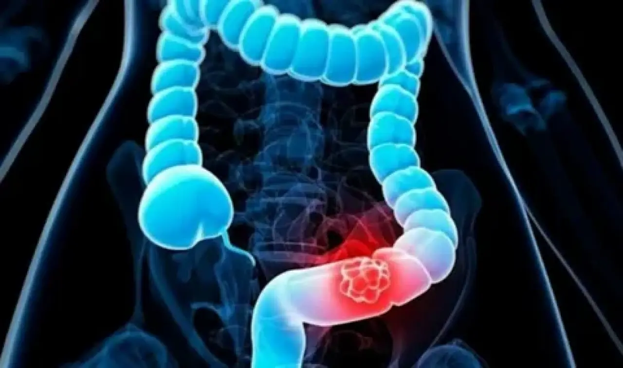 Kolon kanserine karşı egzersiz mucizesi 2