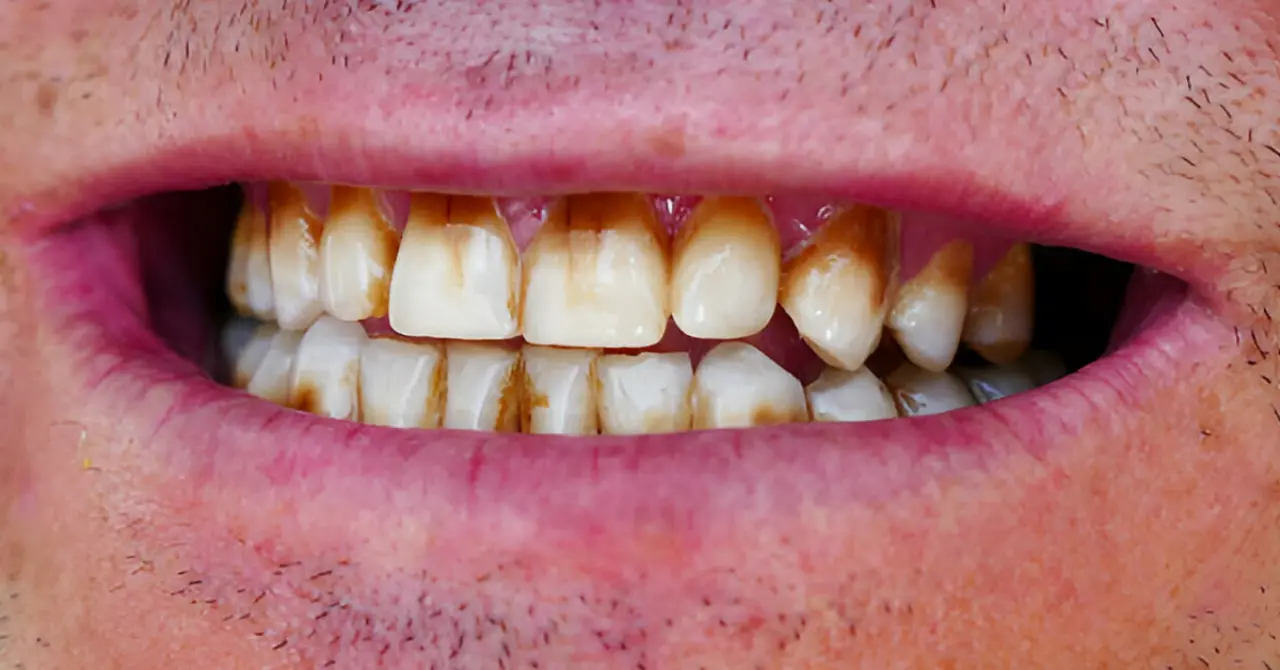 Kahve, sigara, antibiyotik… diş renginiz neden bozuluyor? 1