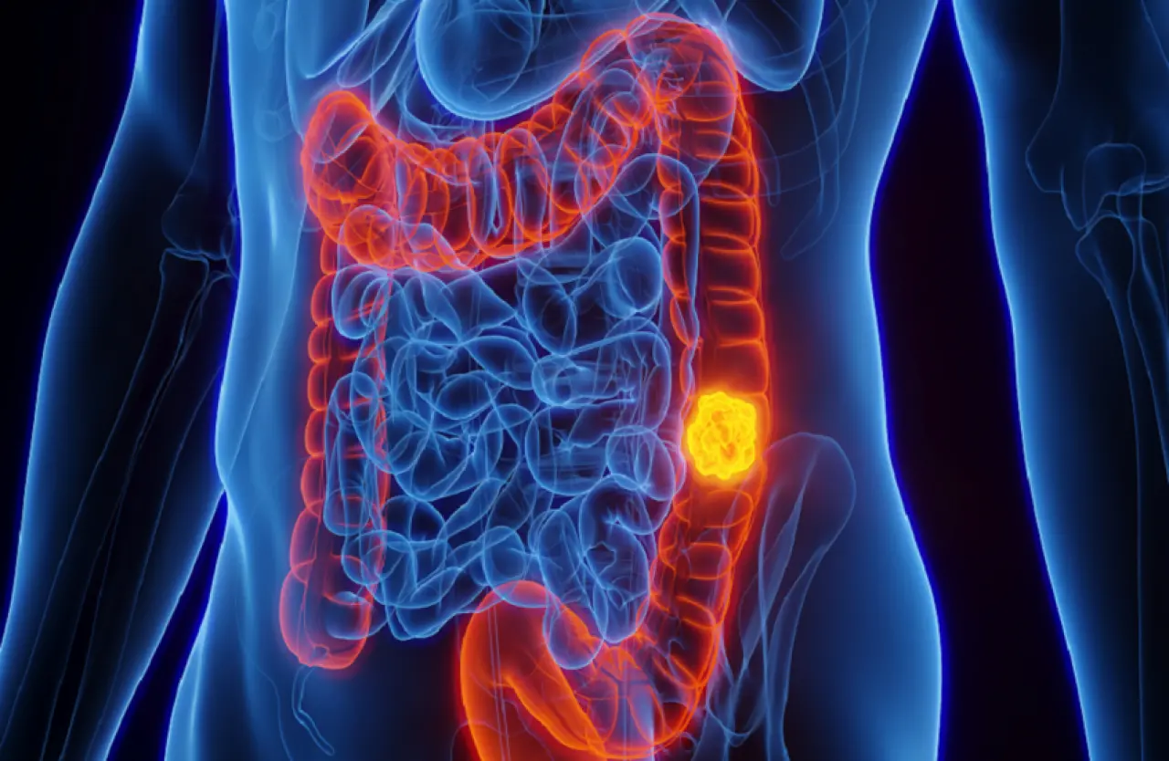 Kolon kanserine karşı egzersiz mucizesi 1