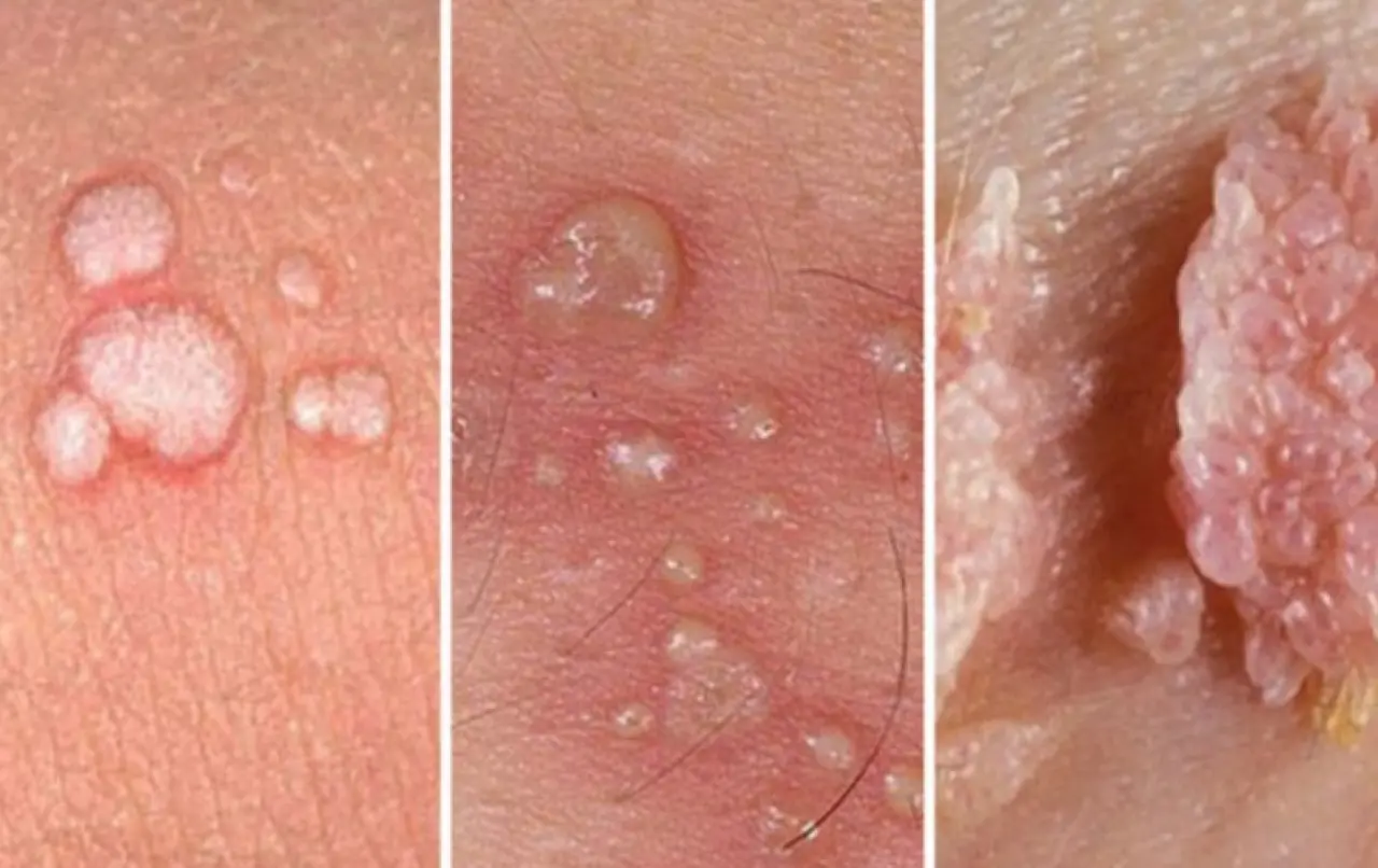 HPV Belirtileri, Aşısı Nedir, Ne İşe Yarar? İşte Tüm Merak Edilenler 2