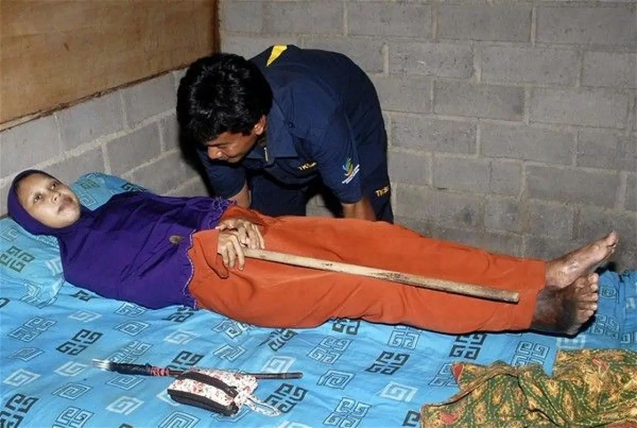 Dünyanın en tuhaf hastalıkları 5