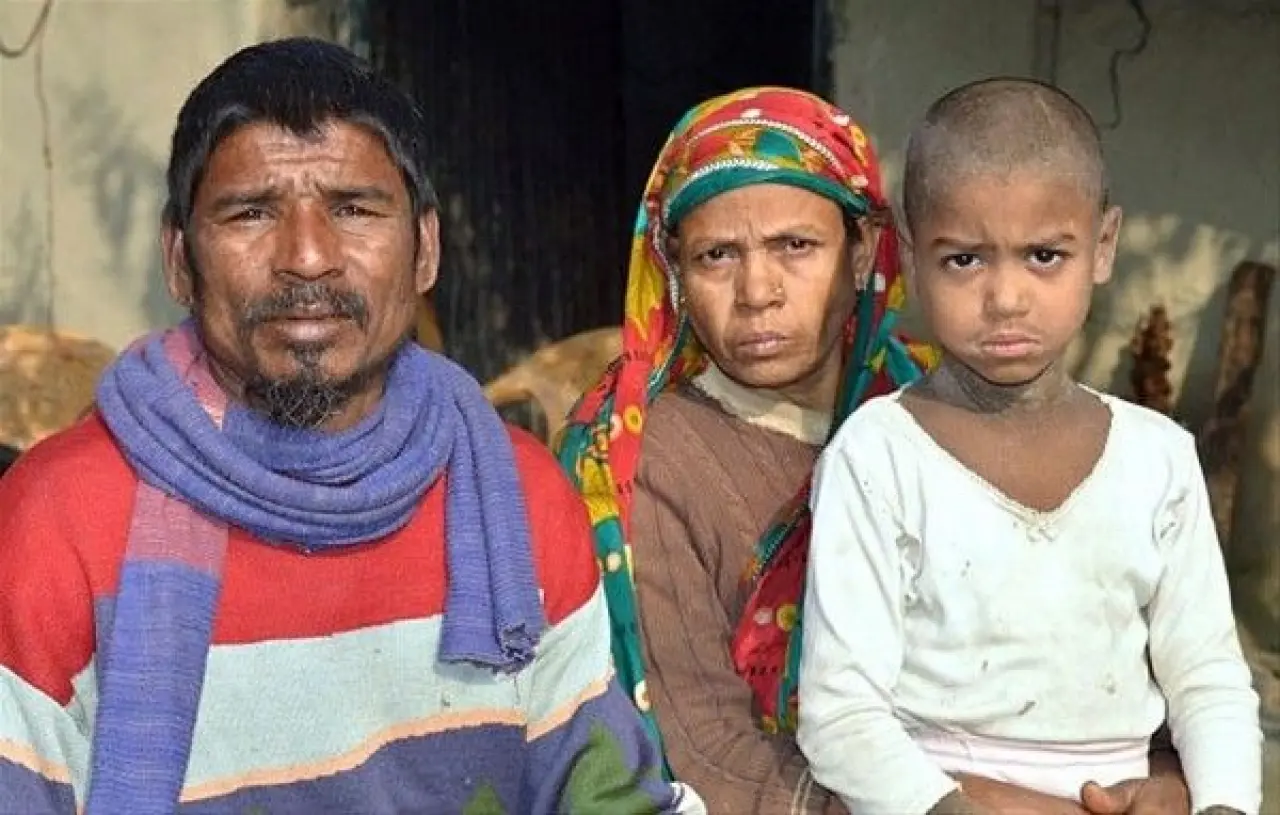 Dünyanın en tuhaf hastalıkları 7