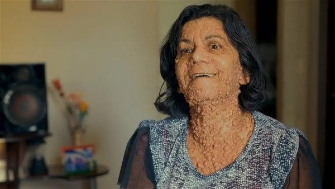 Dünyanın en tuhaf hastalıkları 15