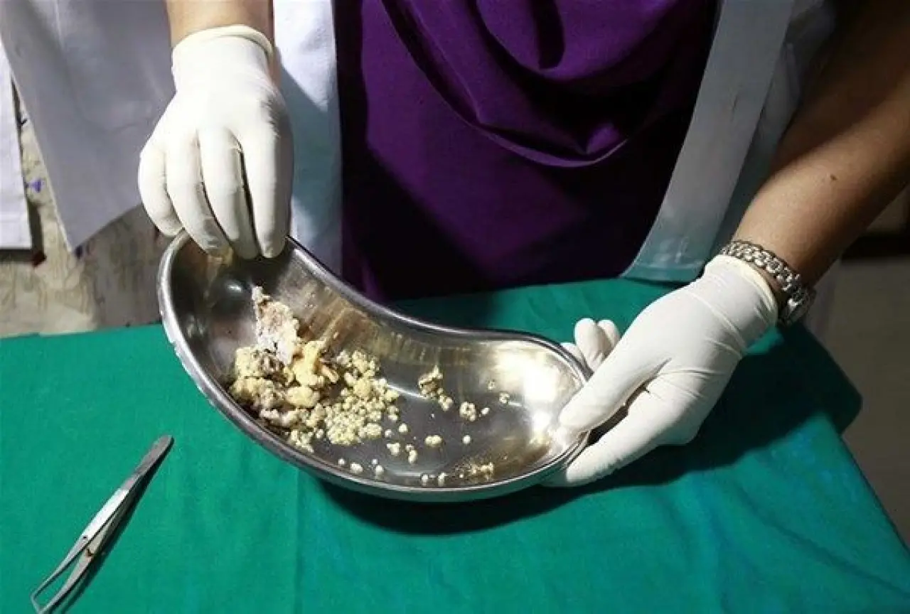 Dünyanın en tuhaf hastalıkları 17