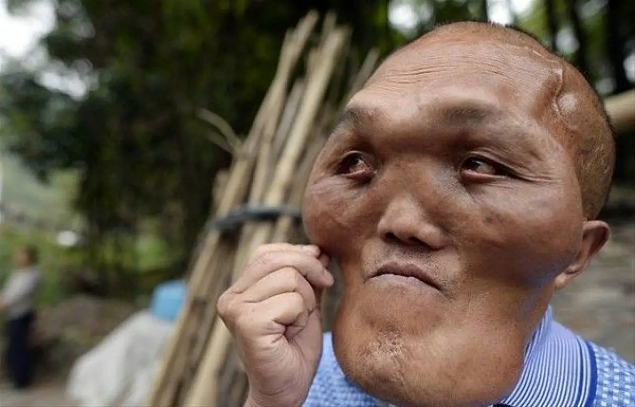 Dünyanın en tuhaf hastalıkları 4