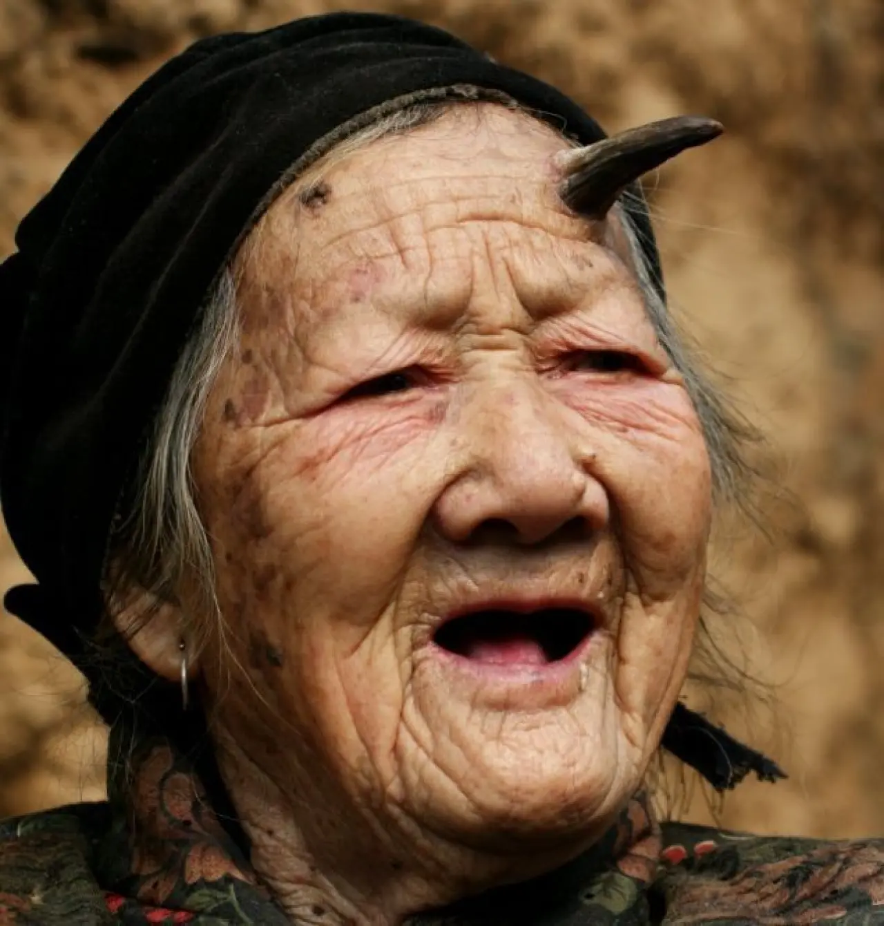 Dünyanın en tuhaf hastalıkları 1