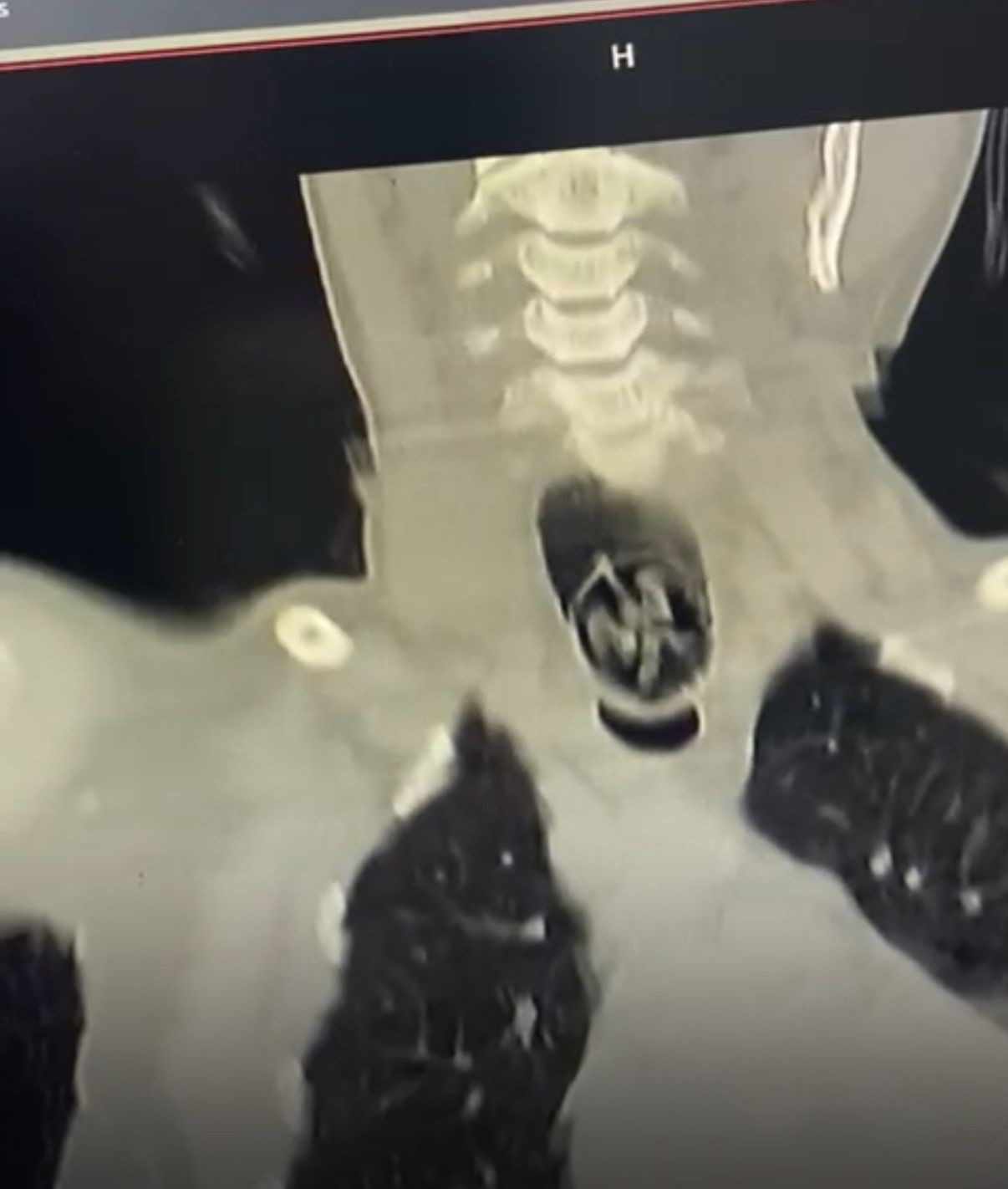 agrida-yuttugu-ceviz-yemek-borusundan-cikarildi