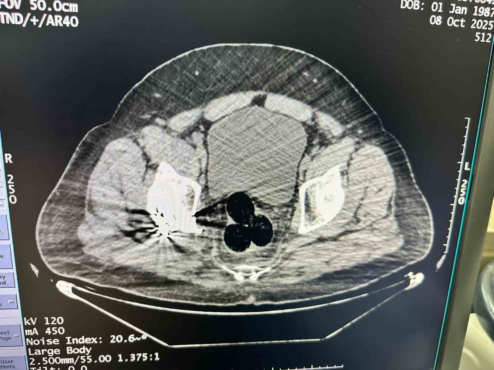 igdirda-uyusturucu-operasyonu-makatindan-130-gram-uyusturucu-cikti
